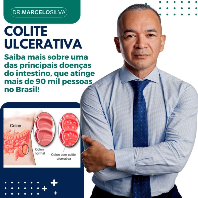 Colite Ulcerativa